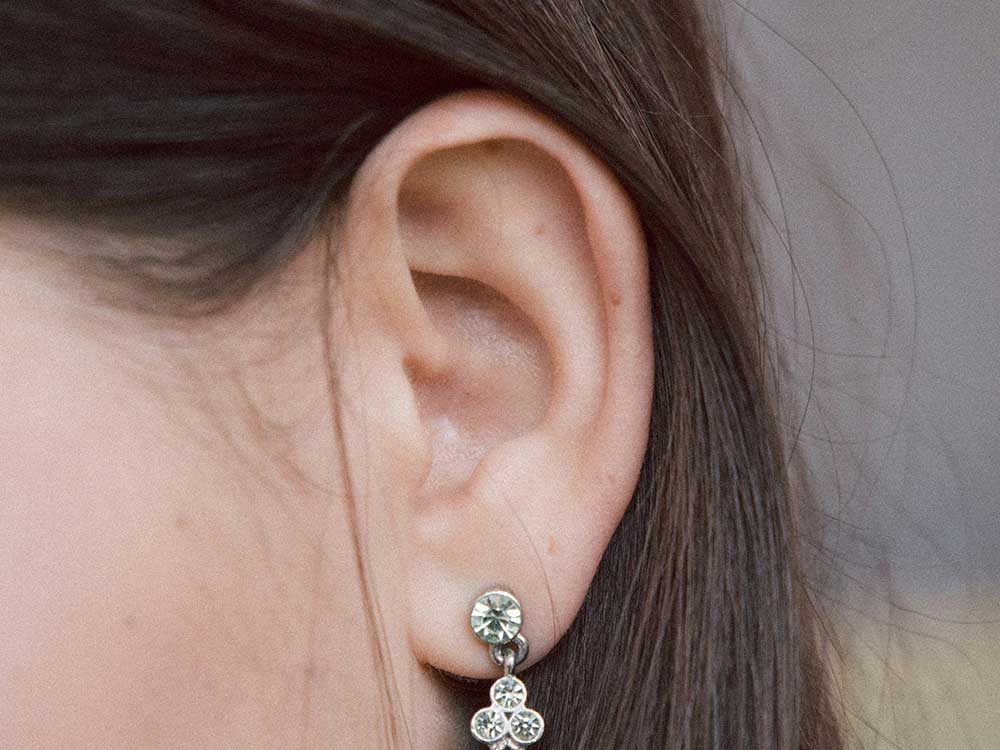 Vorher Nachher Bilder zur Ohrkorrektur